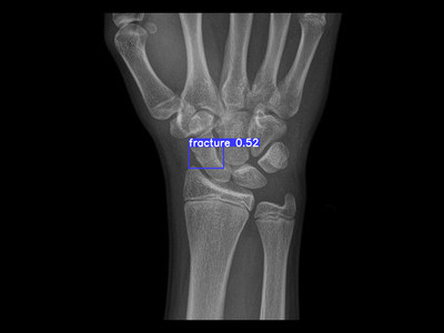 Detecção de fratura do escafóide em Raio X