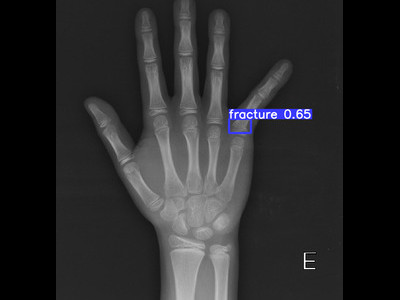 Detecção de fratura da falange proximal em Raio X