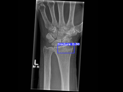 Detecção de fratura do rádio distal em Raio X