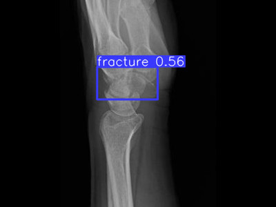 Detecção de fratura do piramidal em Raio X