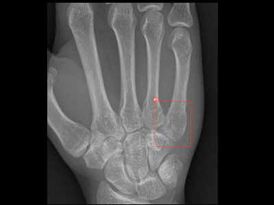 Detecção de fratura do quinto metarcapo em Raio X