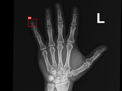 Detecção de fratura da falange distal em Raio X