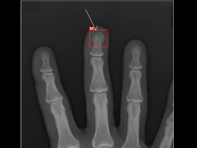 Detecção de fratura da falange distal em Raio X